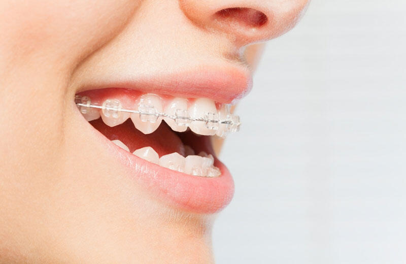 Close-up of a person smiling with clear ceramic braces used for discreet orthodontic teeth alignment