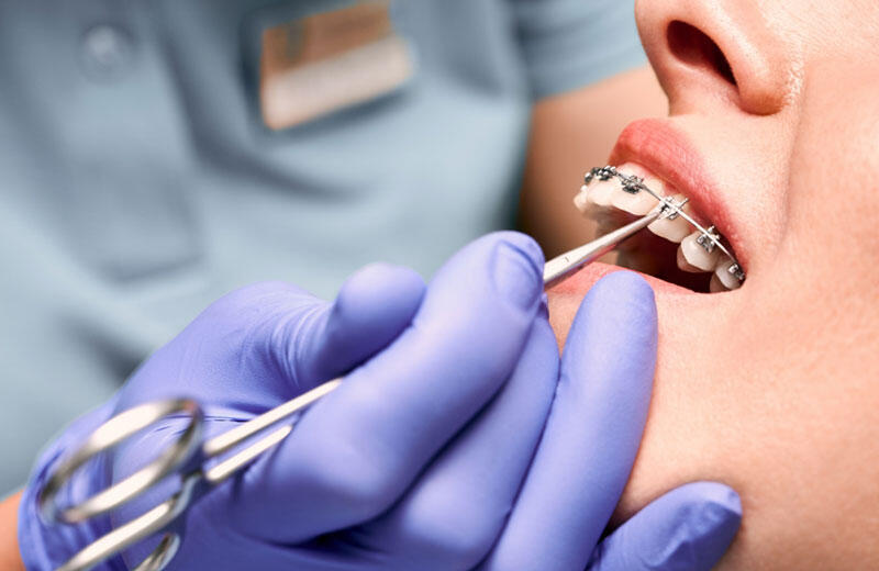 Orthodontist adjusting metal braces on a patient’s teeth using dental tools