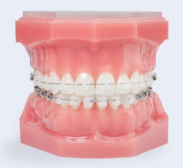 Teeth alignment