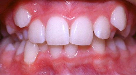 Dental crowding in upper teeth before orthodontic correction