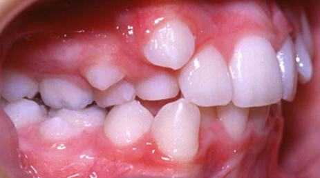 Close-up of crowded and misaligned teeth showing dental crowding