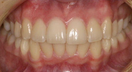 Front view of well-aligned teeth after orthodontic treatment
