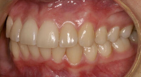 Lateral view of well-aligned teeth showing corrected bite