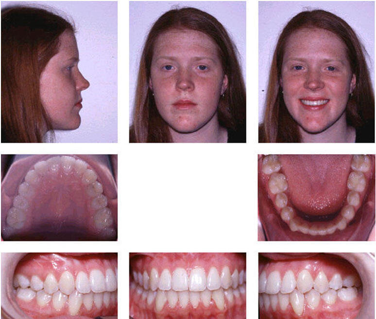 upper jaw development