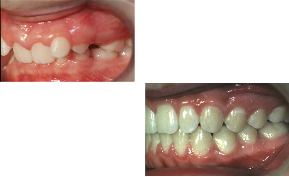open bite treatment