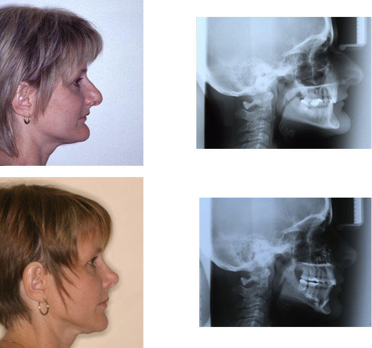 lip profile concavity