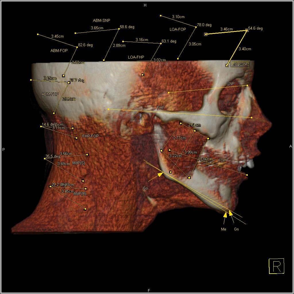 CT Axial Face Anatomy