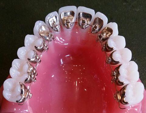 Incognito Lingual braces