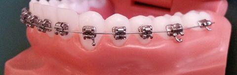 Self ligating braces