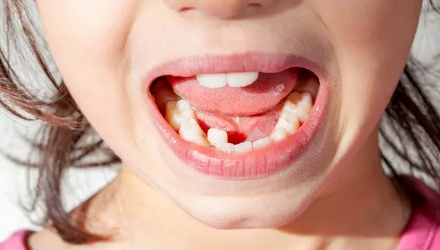 Can Crowded Teeth Cause Gum Disease or Tooth Decay
