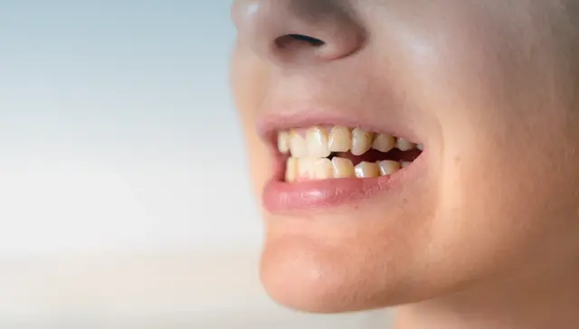 Class III Bite Problems Causes, Effects, and Treatment Options