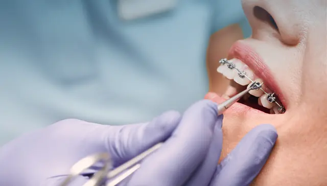 How Long Do Braces Take A Guide for Armadale Patients
