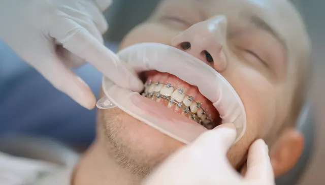 Benefits of Orthodontic Treatment for Adults in Armadale
