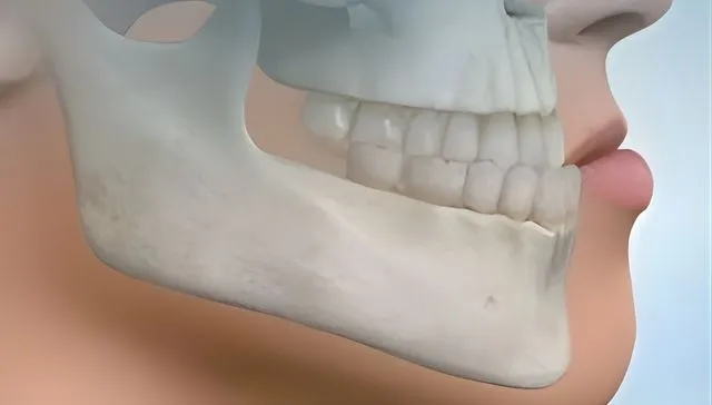 Class III malocclusion large lower jaw treatment options Armadale