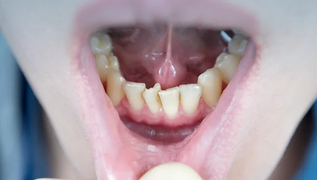 Teeth Crowding