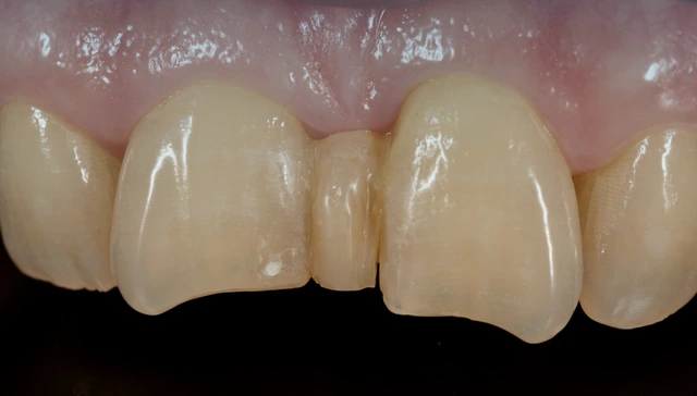 Orthodontic treatment for dental crowding with braces