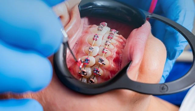 Why Armadale Families with Complex Orthodontic Conditions Trust Michael Woods Orthodontics