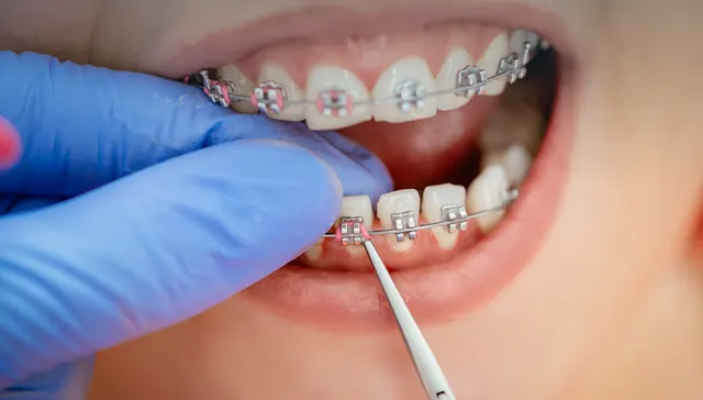 Why Teeth Move After Braces Advice for Armadale Patients