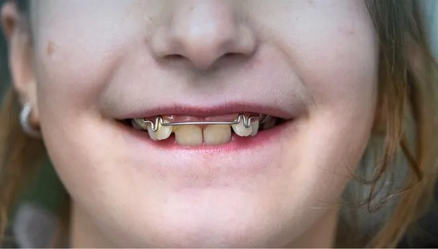 Orthodontic Treatment