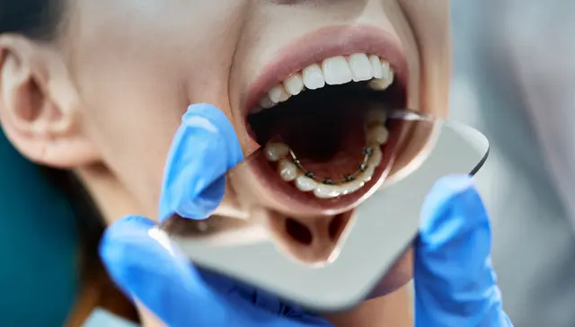 Lingual braces fitted behind teeth at Michael Woods Orthodontics Armadale