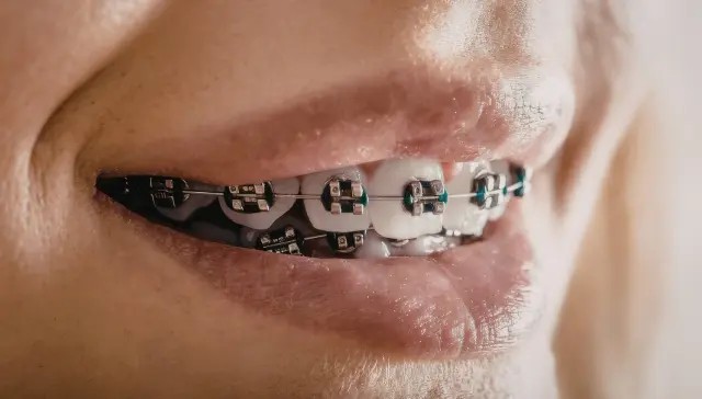 Orthodontic Treatment Costs in Armadale What to Budget and What to Ask