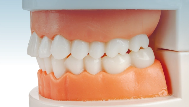 What Is a Crossbite and Why Should It Be Corrected Early