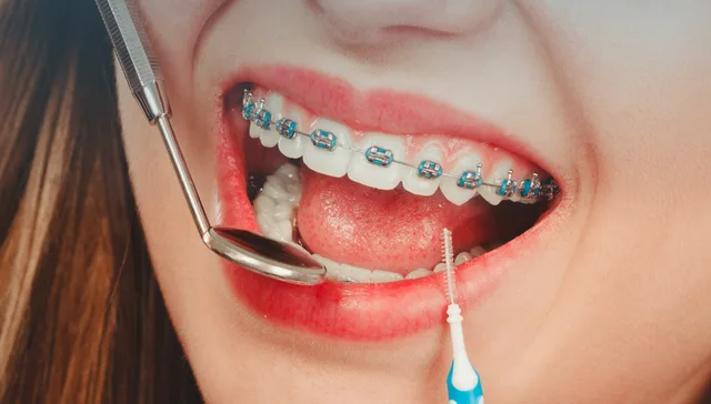 Braces Cost in Armadale VIC