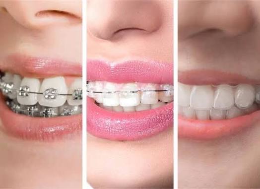 ceramic braces vs clear aligner