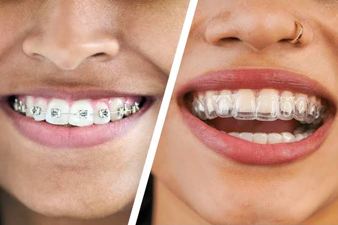 lingual braces vs clear aligners